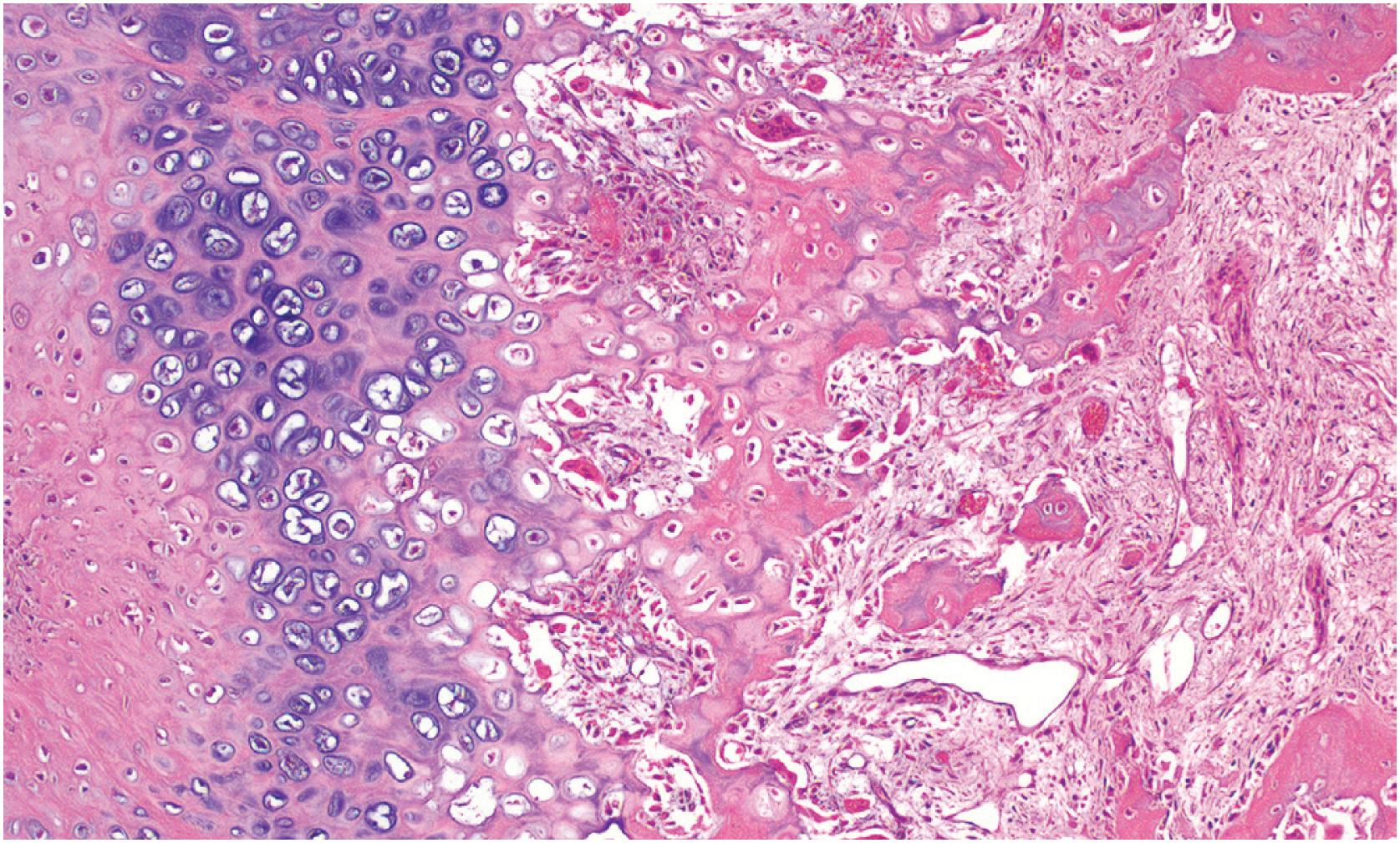 Fig. 17.20, Histologically bizarre parosteal osteochondromatous proliferation (BPOP) shows hypercellular hyaline cartilage undergoing endochondral ossification and a transition to woven bone. The mineralization has a basophilic appearance.