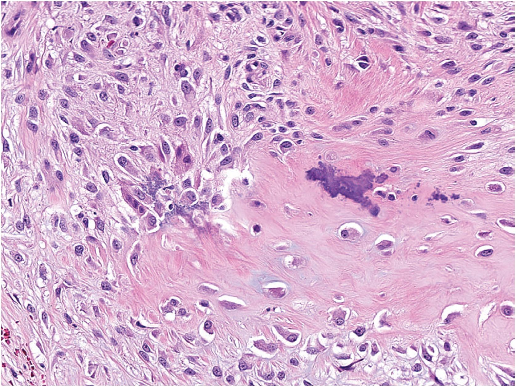 Fig. 17.22, Subungual exostosis demonstrates spindle cells associated with osteoid that focally mineralizes.