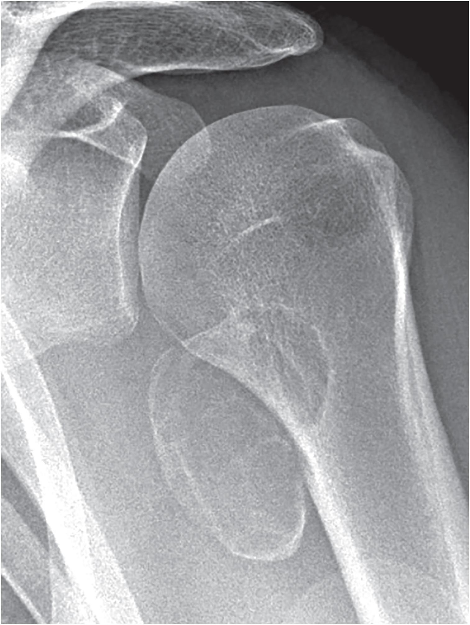 Fig. 17.23, Plan radiograph of a periosteal chondroma shows a pedunculated mass on the surface of the proximal humerus with a well-defined, sclerotic margin.