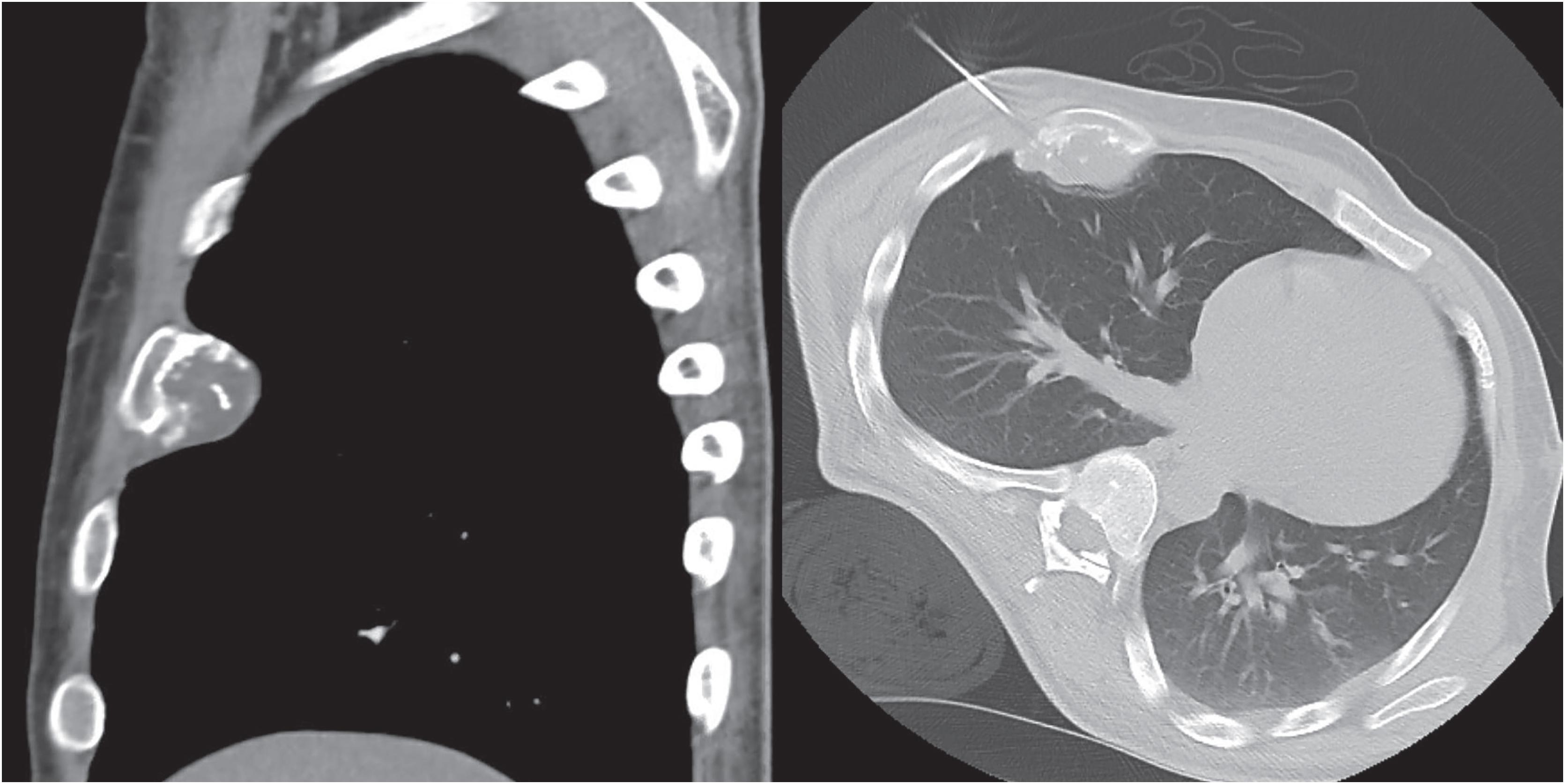 Fig. 17.24, CT images of a large periosteal chondroma show a lobulated mass on the surface of the anterior fourth rib with internal calcification. The cortex of the rib appears intact (left). Core biopsy of surface cartilaginous tumors (right) may be challenging to interpret as surface tumors may demonstrate increased cellularity and needle biopsies can impede the ability to assess architecture.