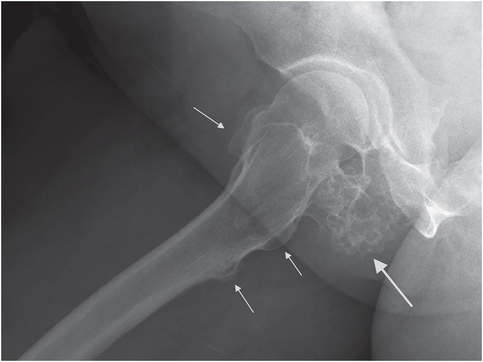 Fig. 17.6, A pedunculated osteochondroma involving the right femoral neck ( large arrow ). Several smaller osteochondromas are visible throughout the surface of the proximal femur ( small arrows ), and each lesion shows cortico-medullary continuity with the underlying bone.