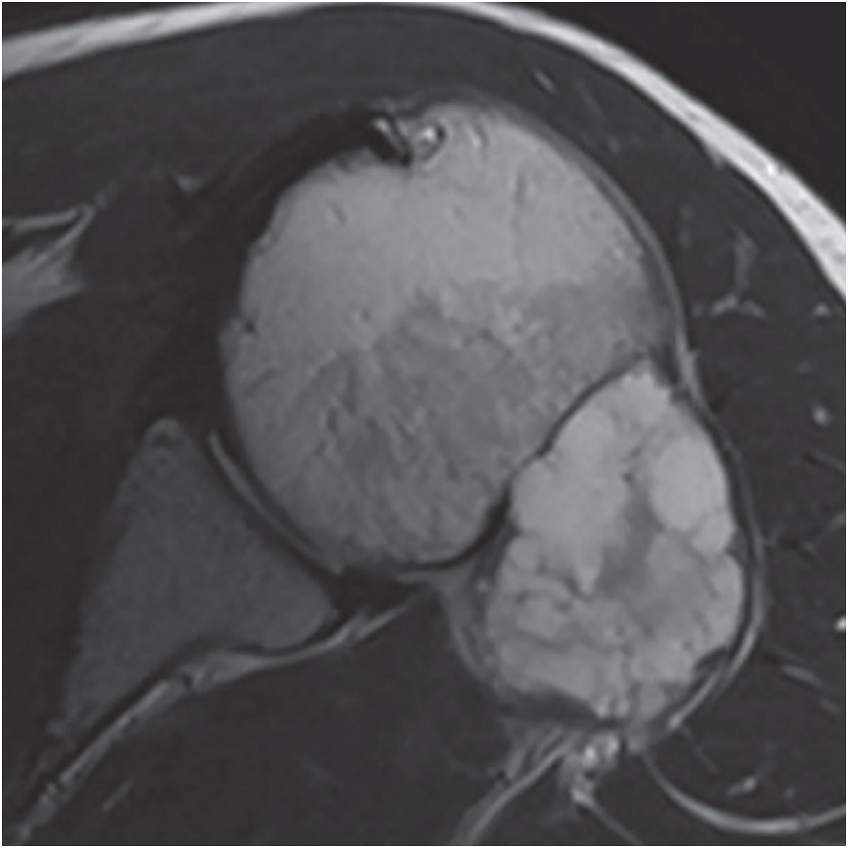 Fig. 17.25, On MRI, periosteal chondroma is a lobular, surface-based, heterogeneously T2-bright tumor.