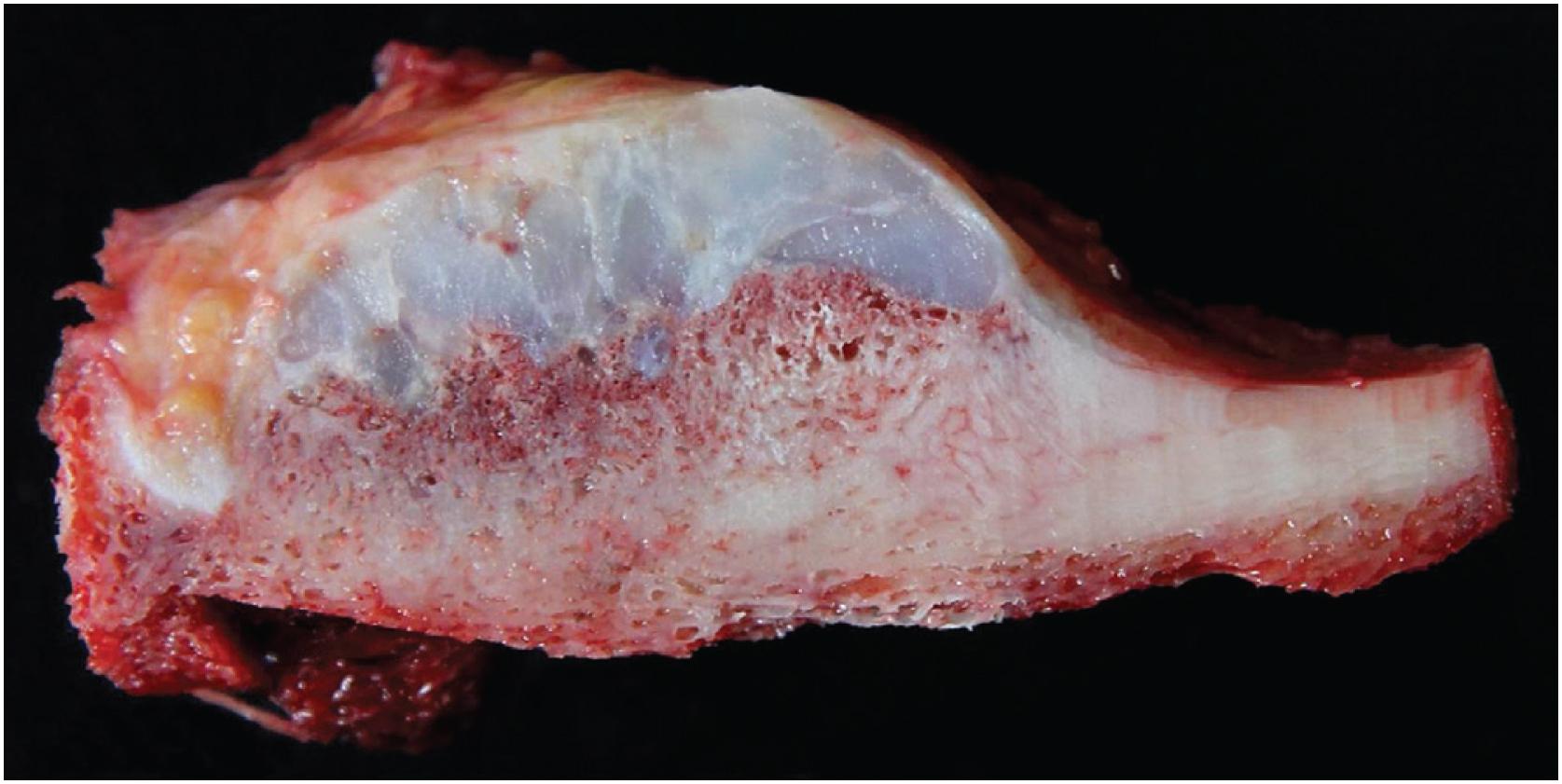 Fig. 17.26, Gross resection of a periosteal chondroma shows a multinodular tumor composed of glistening white cartilaginous nodules. The tumor is located on the surface of the rib and focally impinges upon the medullary cavity with a smooth border.