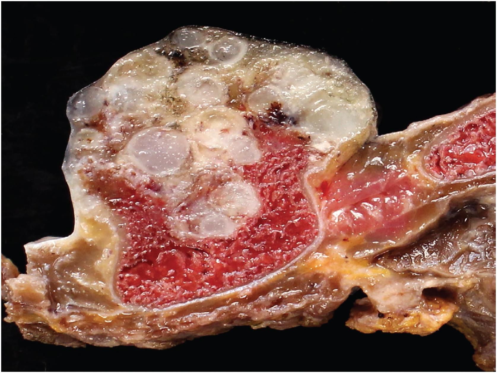 Fig. 17.27, A periosteal chondroma presents as a glistening blue-white cartilaginous nodule on the surface of the bone. The tumor arises beneath the periosteum and is associated with cortical buttressing.