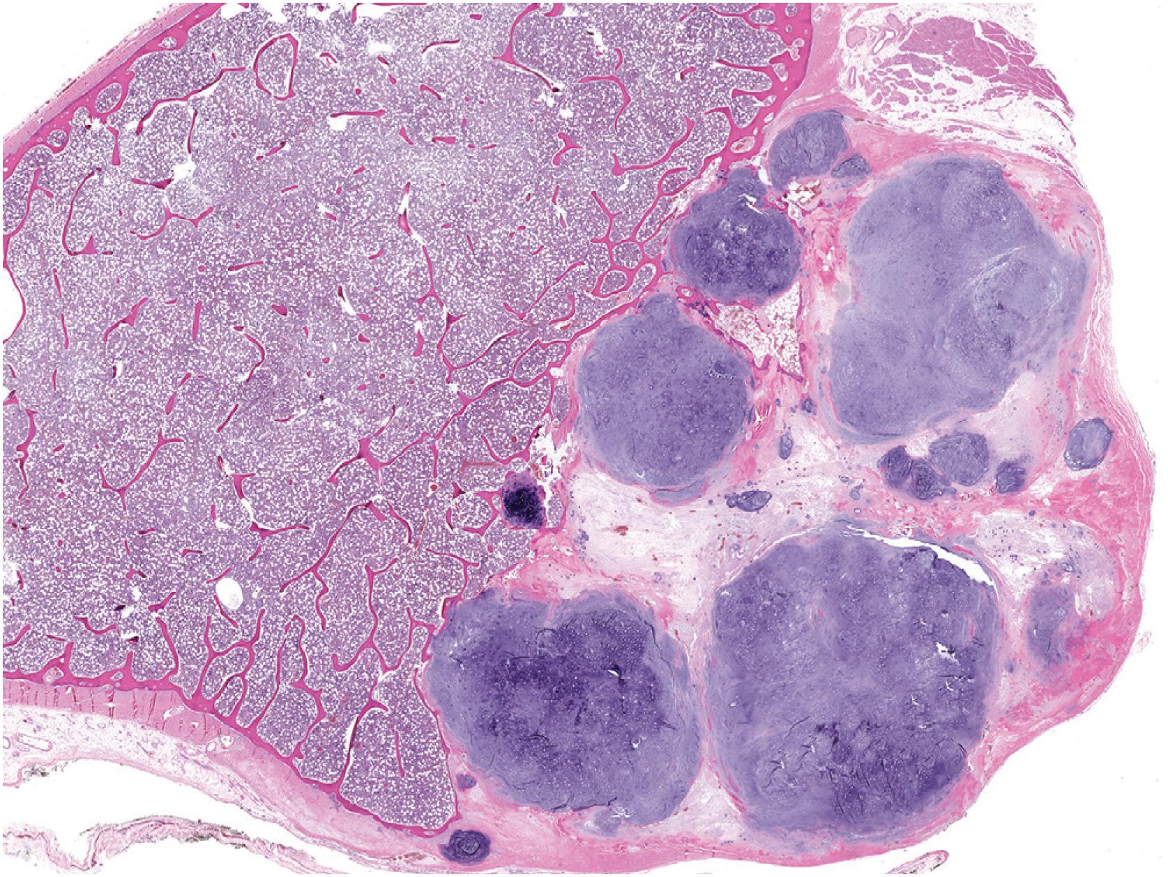Fig. 17.28, A low-power histologic image of periosteal chondroma shows a subperiosteal surface cartilaginous tumor. The tumor is multinodular and demonstrates a well-demarcated border between the lesion and the underlying cortex.