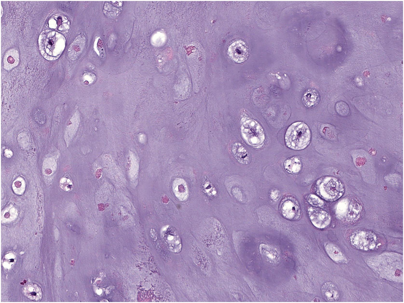 Fig. 17.30, On high power, periosteal chondroma demonstrates low to moderate cellularity, small chondrocytes, and scattered regions of chondrocyte drop out.