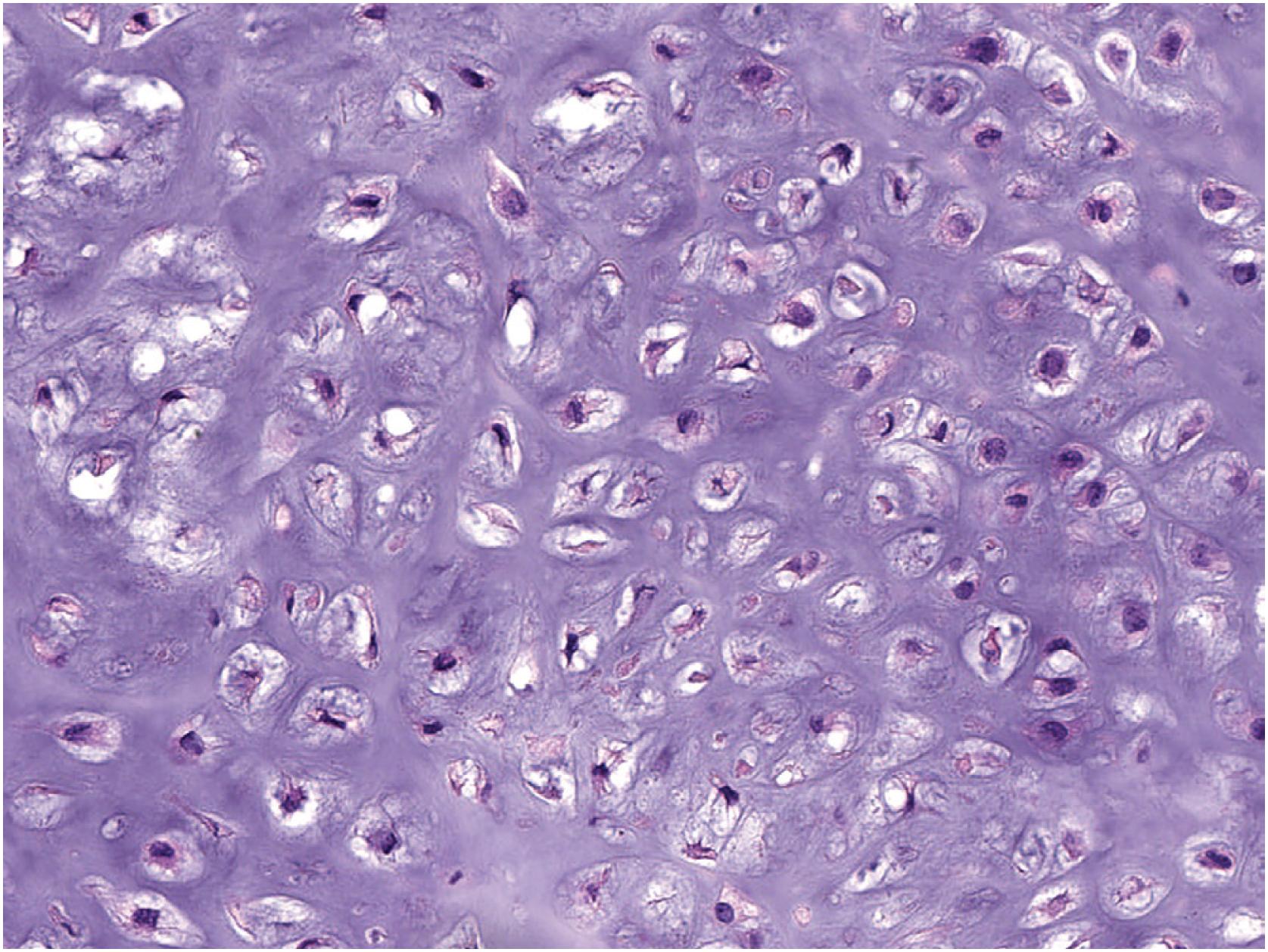 Fig. 17.31, Some cases of periosteal chondroma show hypercellularity, a feature that does not in isolation denote malignancy.