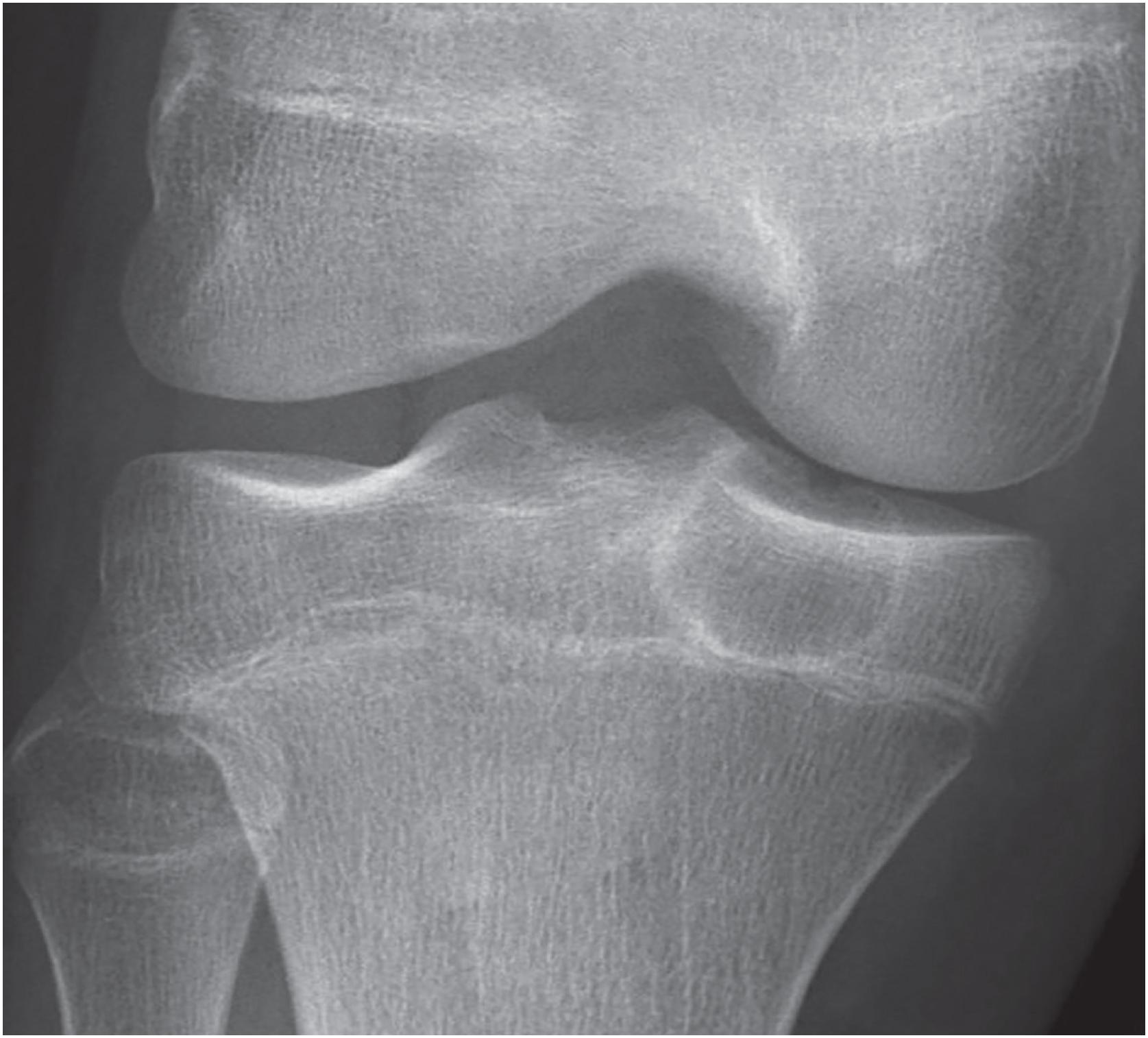 Fig. 17.32, Chondroblastoma is the prototypical epiphyseal lesion of skeletally immature individuals. This tibial epiphyseal lesion is lytic with a well-defined sclerotic margin.