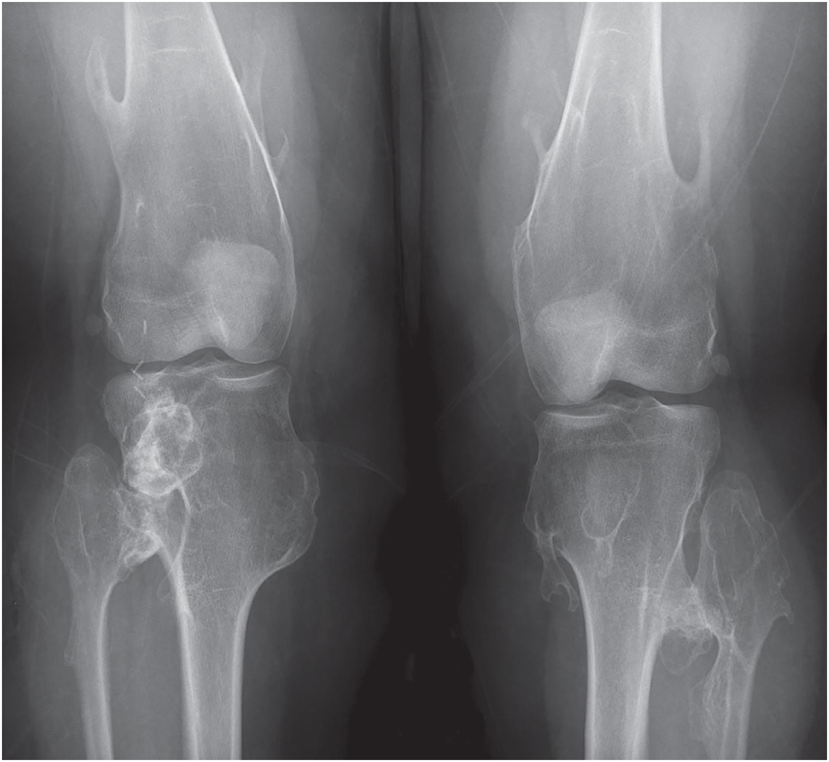 Fig. 17.7, Innumerable osteochondromas are present in a patient with multiple hereditary exostoses. The multiple exostoses involve bilateral distal femurs, proximal tibias, and proximal fibulas, and many characteristically point away from the adjacent knee joint.