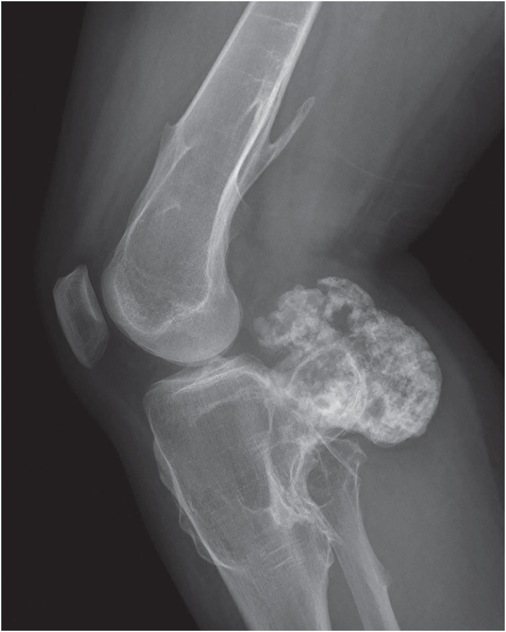 Fig. 17.8, Radiograph of a large osteochondroma of the posterior tibia shows irregular mineralization. The tumor was surveyed over time radiographically and showed growth over several years.