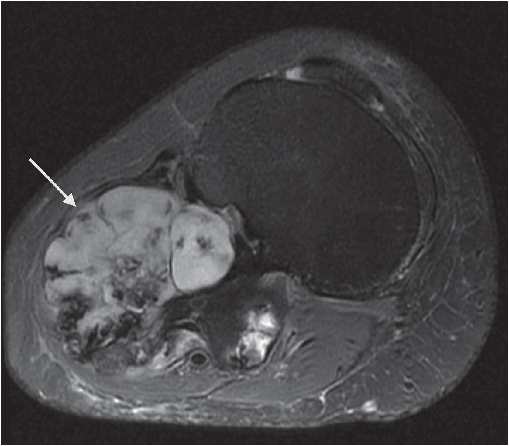 Fig. 17.9, MRI of this osteochondroma demonstrates a large T2 hyperintense cartilaginous cap ( arrow ), raising suspicion for chondrosarcomatous transformation. The areas of low signal intensity correspond to mineralization on plain radiographs.