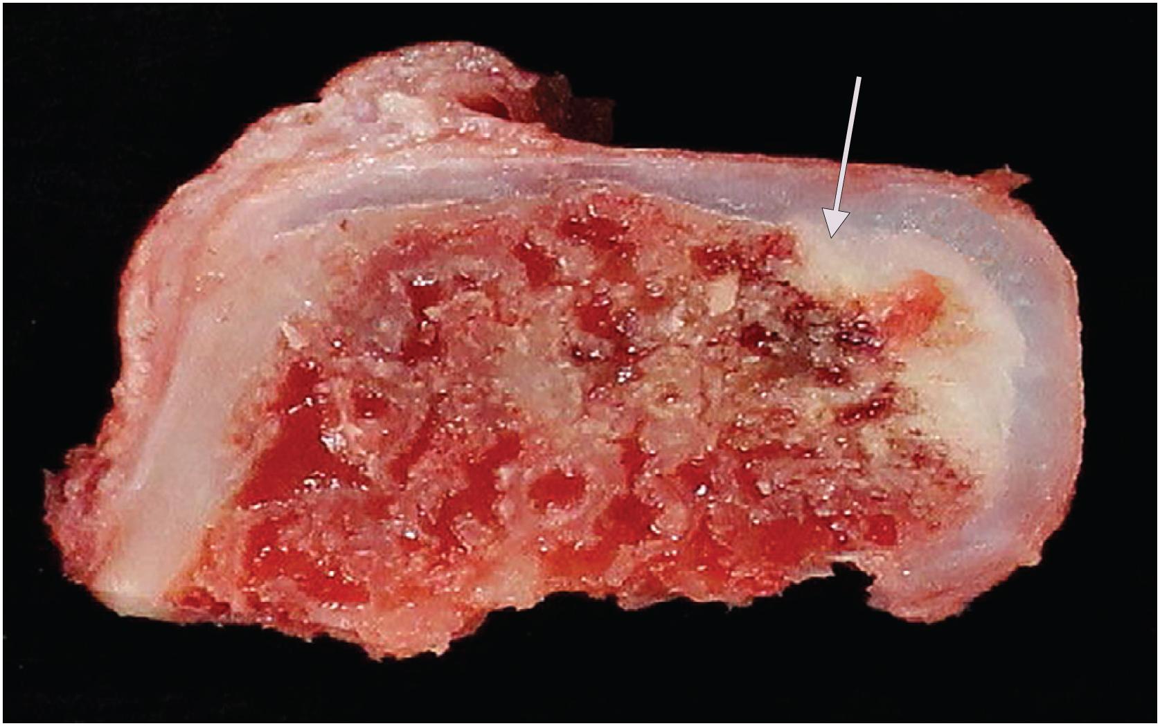 Fig. 17.12, This resected osteochondroma shows prominent bone deposition at the base of the cartilage cap (arrow). This mineralization is indicative of endochondral ossification and tumor growth cessation.