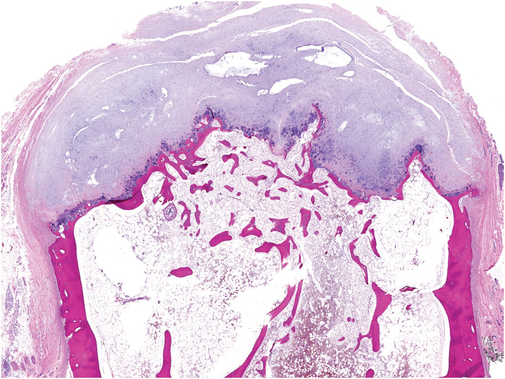 Fig. 17.13, Low power highlights the orderly histologic arrangement of this osteochondroma. The cartilage cap is surfaced by fibrous perichondrium and the base has undergone endochondral ossification.