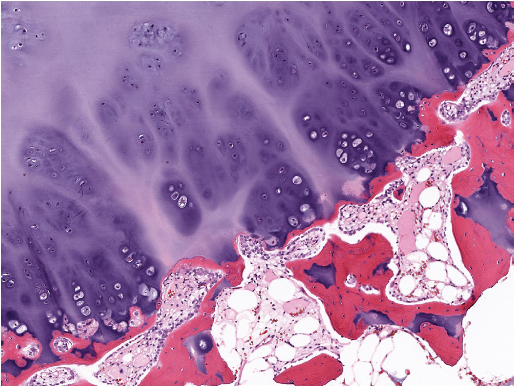 Fig. 17.14, The growth of osteochondroma recapitulates growth plate architecture, with chondrocytes organized in columns.