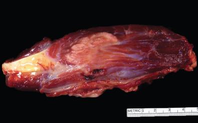 Figure 14.1, Gross Appearance of Myositis Ossificans.