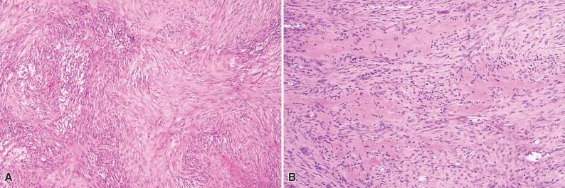 Figure 14.2, Myositis Ossificans.