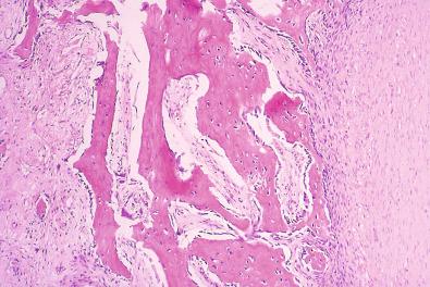 Figure 14.3, Myositis Ossificans.