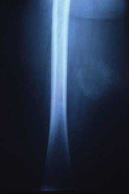 Figure 14.4, Myositis Ossificans.