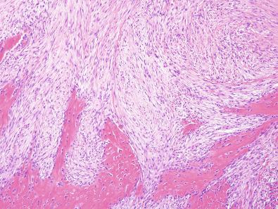 Figure 14.5, Fibro-osseous Pseudotumor of the Digits.