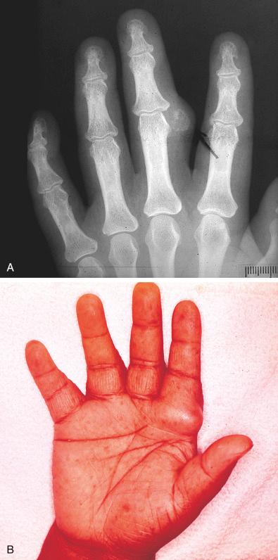 Fig. 30.1, Chondroma of Soft Parts.