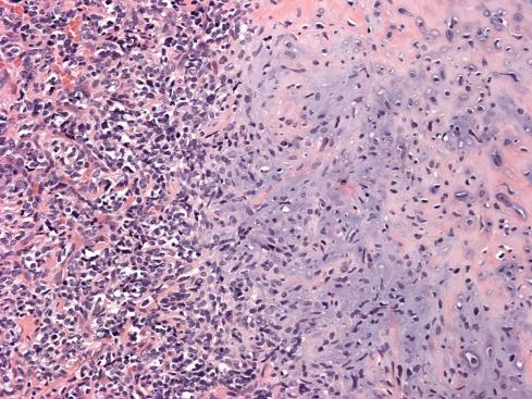 Fig. 30.11, Low-power view of mesenchymal chondrosarcoma with its characteristic bimorphic picture: islands of well-differentiated cartilage abutting sheets of small, undifferentiated tumor cells.