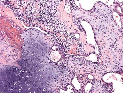 Fig. 30.12, Demarcation between small, undifferentiated tumor cells and well-differentiated cartilage in mesenchymal chondrosarcoma.