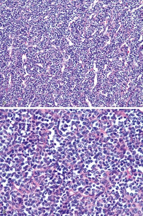 Fig. 30.14, A, Small round cells surround a prominent hemangiopericytoma-like vasculature in extraskeletal mesenchymal chondrosarcoma. B, Rounded cells have high nuclear/cytoplasmic ratio but more variability in nuclear shape than in classic Ewing sarcoma.