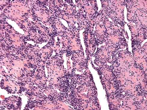 Fig. 30.15, High-power view of small round cells surrounding collagen cores in extraskeletal mesenchymal chondrosarcoma. Subtle cartilaginous features can sometimes be seen within these areas.