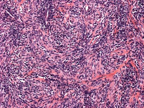 Fig. 30.16, Spindling of primitive cells in extraskeletal mesenchymal chondrosarcoma.