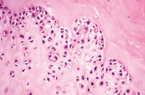 Fig. 30.4, Chondroma of soft parts with hypercellular zone at periphery of lobule.