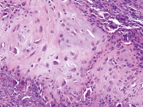 Fig. 30.7, Mild atypia and nuclear enlargement within calcified chondroma (same case as Figure 30.6).