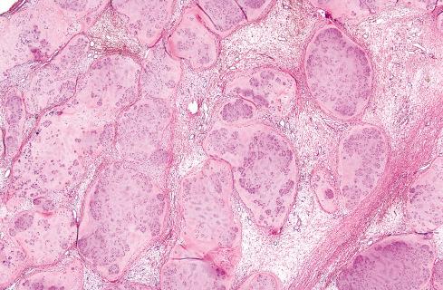 Fig. 30.9, Synovial chondromatosis of left knee.