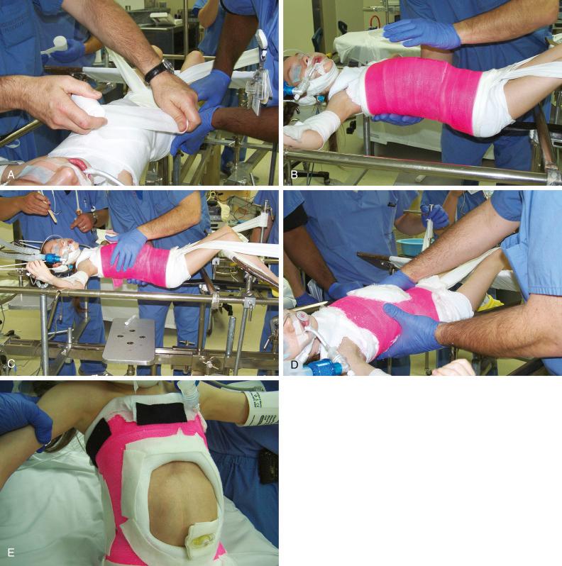 Fig. 3.1, (A) Patient on Risser table with muslin support and molding over iliac crests. (B) Cast molded over chest and iliac crests. (C) Chest mold. (D) Abdominal cutout for breathing comfort. (E) Cast petaled.