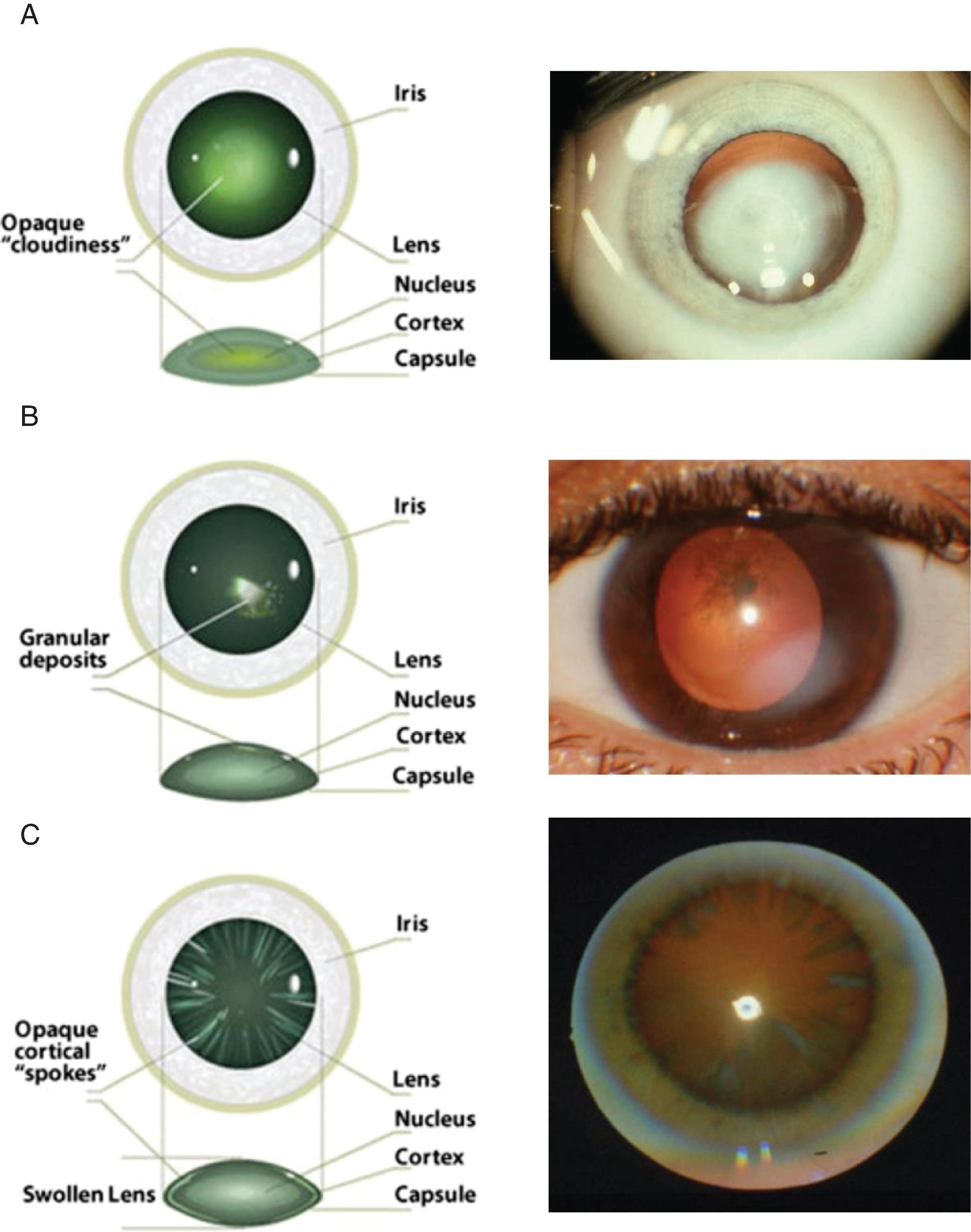 Fig. 65.1, (A) Nuclear cataract in a 3-month-old infant. (B) Posterior subcapsular cataract in a 5-year old. (C) Cortical cataract viewed with retroillumination. ([B] From Thompson J et al: Cataracts. Prim Care. 42(3):409–23, 2015. © 2015 Copyright Elsevier BV. All rights reserved.)