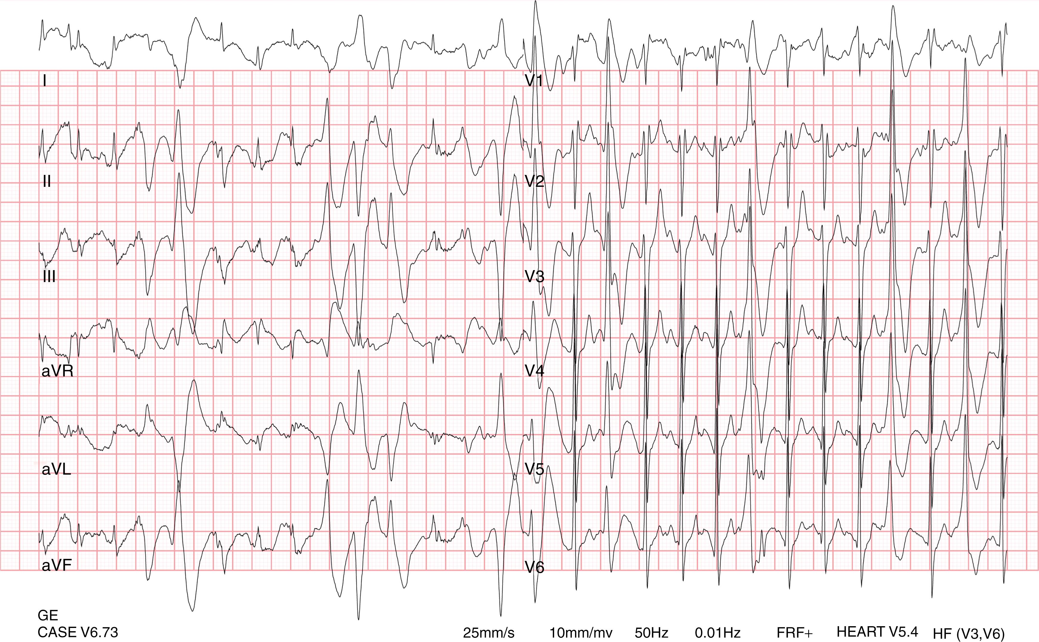 Fig. 91.1, Exercise stress testing in an 18-year-old patient with catecholaminergic polymorphic ventricular tachycardia and a RYR2 mutation.