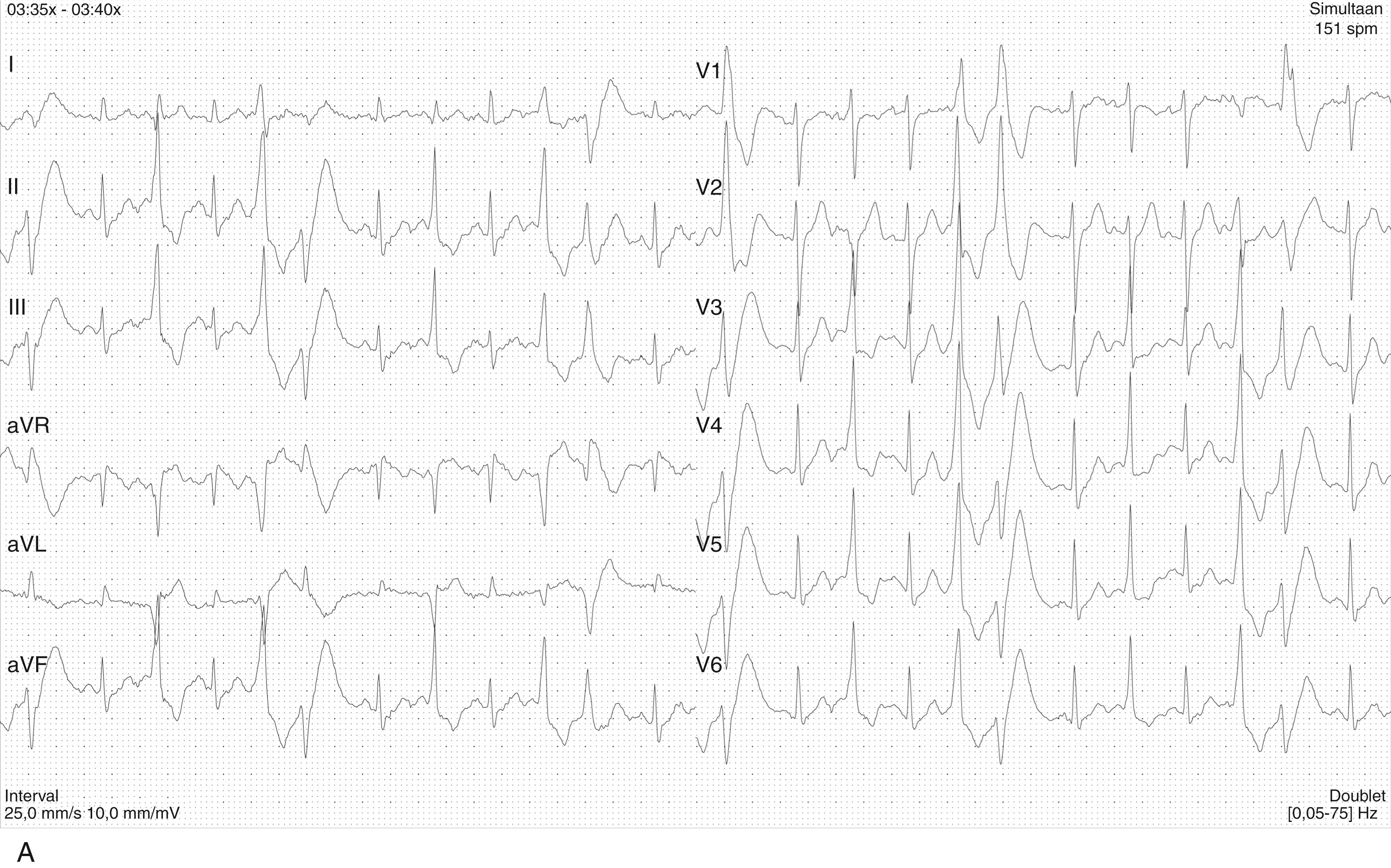 Fig. 91.2, Exercise stress testing in a 24-year-old patient with catecholaminergic polymorphic ventricular tachycardia and an RYR2 mutation.