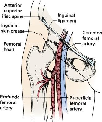 Fig. 15.2, Schematic of common femoral artery anatomical landmarks.