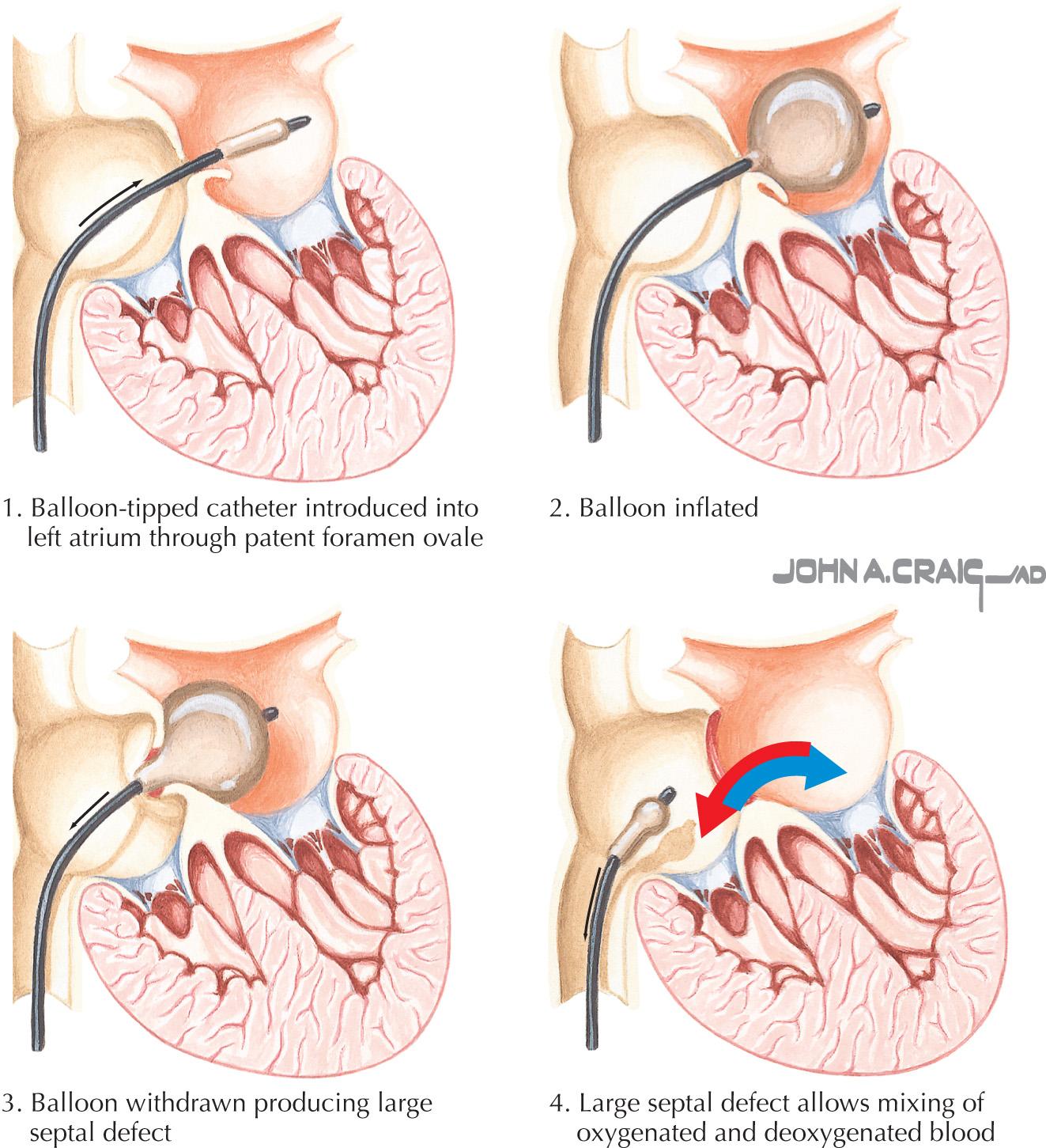 FIG 52.1, Balloon Atrial Septostomy for Transposition of the Great Arteries (see Video 52.1 ).