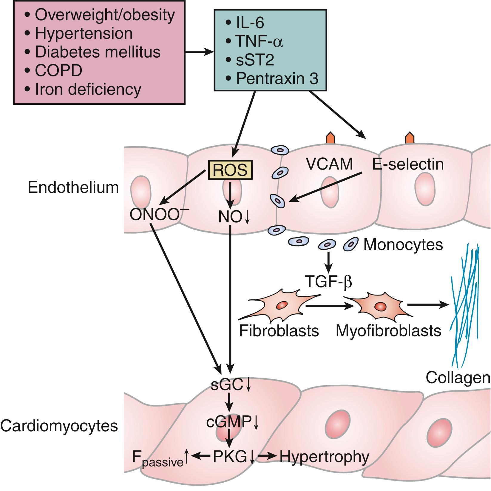 Figure 37.1, Myocardial remodeling in heart failure with preserved ejection fraction: importance of comorbidities. COPD, Chronic obstructive pulmonary disease; F passive , resting tension; cGMP, cyclic guanosine monophosphate; IL-6, interleukin-6; NO, nitric oxide; ONOO−, peroxynitrite; PKG, cGMP-dependent protein kinase; ROS, reactive oxygen species; sGC, soluble guanylyl cyclase; sST2, somatostatin receptor 2; TGF-β, transforming growth factor-β; TNF-α, tumor necrosis factor-α; VCAM, vascular cell adhesion protein.