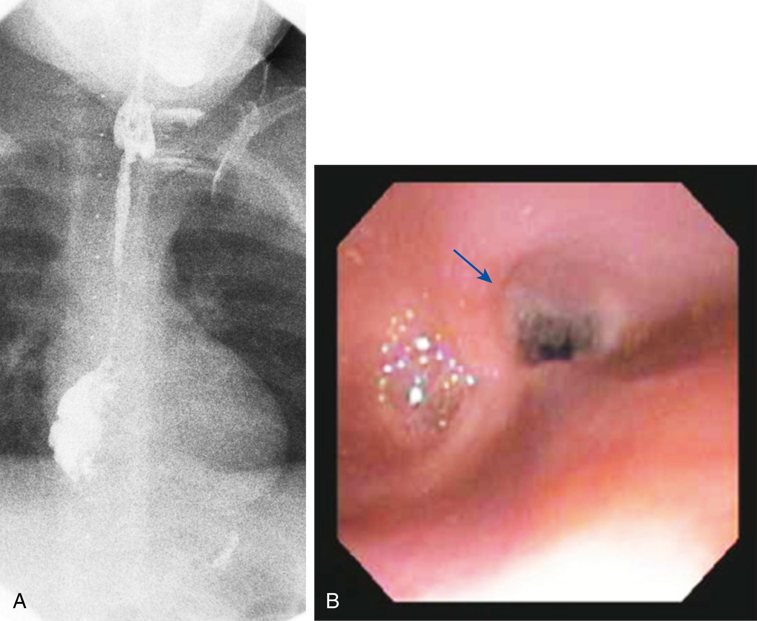 Fig. 18.1, (A and B) Esophagram of a 5-year-old boy demonstrating a long stricture after a lye ingestion. (B) Endoscopic view of the same patient in the proximal esophagus looking at the top of the stricture. The arrow is pointing to the area of the stricture.