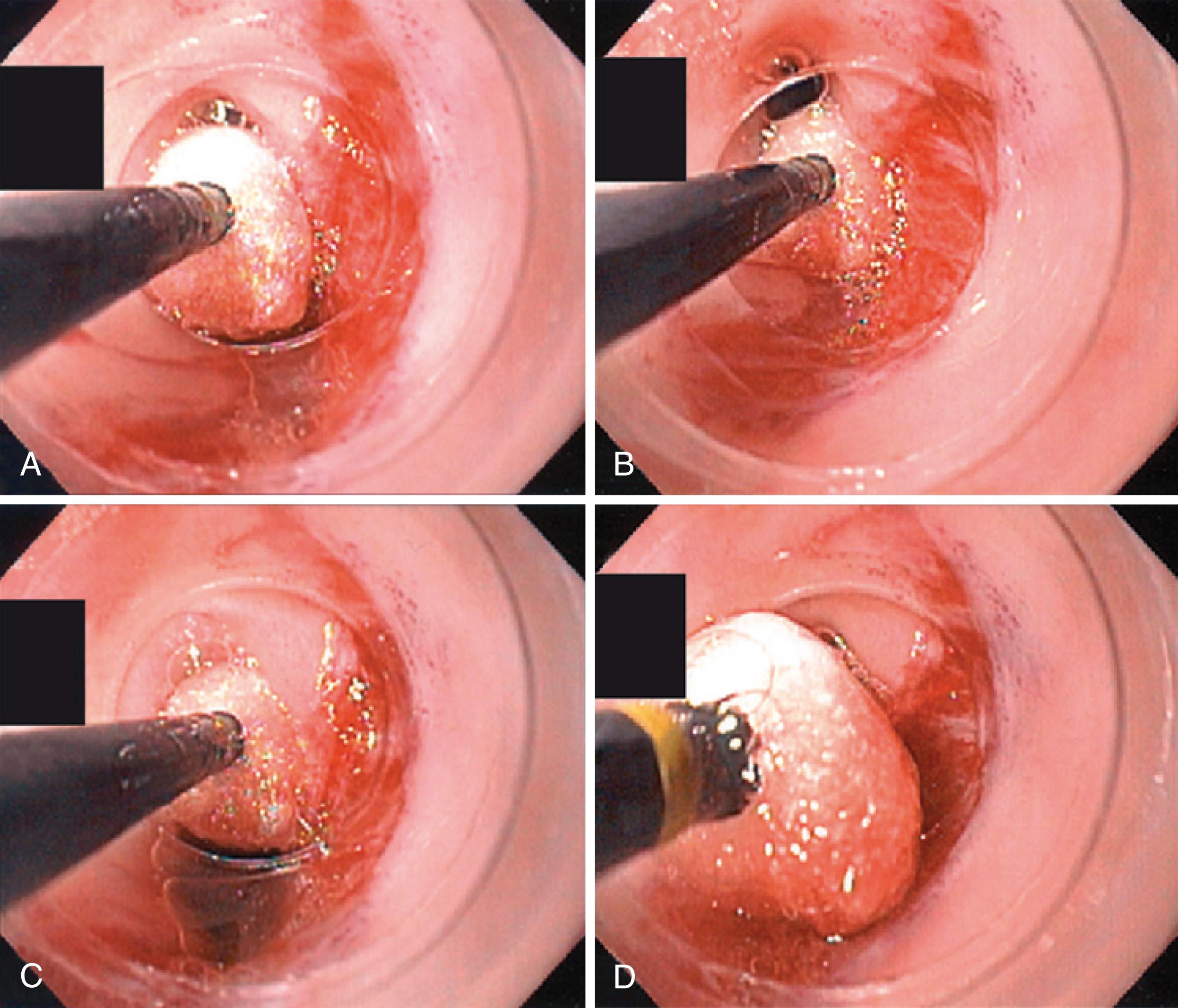 Fig. 18.2, Application of mitomycin C to dilated, stenotic lesion in the esophagus. (A) Dry pledget is advanced from clear plastic hood on endoscope. (B) Mitomycin C is injected down forceps sheath onto pledget. (C) Pledget is held on mucosa at site of dilation. (D) Pledget is withdrawn into hood for safe removal.