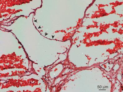 Figure 21.1, Histologic picture of a human cavernous malformation shows a single layer of endothelial cells ( arrowheads ) surrounding sinusoidal spaces with thrombosed red blood cells within them. Note the lack of normal brain parenchyma within the lesions. Hematoxylin and eosin (H&E) stain. Scale bar represents 5 µm.