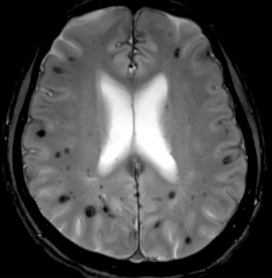 Figure 21.2, Axial T2 gradient echo MRI image demonstrating multiple hypointense areas consistent with multiple cerebral cavernous malformations in a patient with familial multiple cavernoma syndrome.