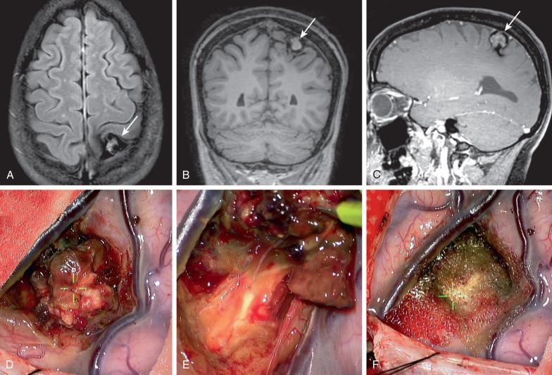 Figure 21.3, A 45-year-old female presented with right hemibody paresthesias and numbness. (A) Axial FLAIR MRI demonstrating a left parietal lesion with hypointense margin consistent with a cavernoma (white arrow) . The lesion is again demonstrated on a coronal T1 and sagittal T1 postcontrast MRI image (white arrow) . (D) Operative view with cavernoma surrounded by two cortical veins. Characteristic mulberry like appearance of cavernoma with dilated vascular channels and blood at different stages noted. (E) Hemosiderin stained pseudocapsule around the lesion with small capillary feeders seen. (F) Resection bed lined with surgical hemostatic fabric. Hemosiderin not removed given proximity to sensorimotor cortex.