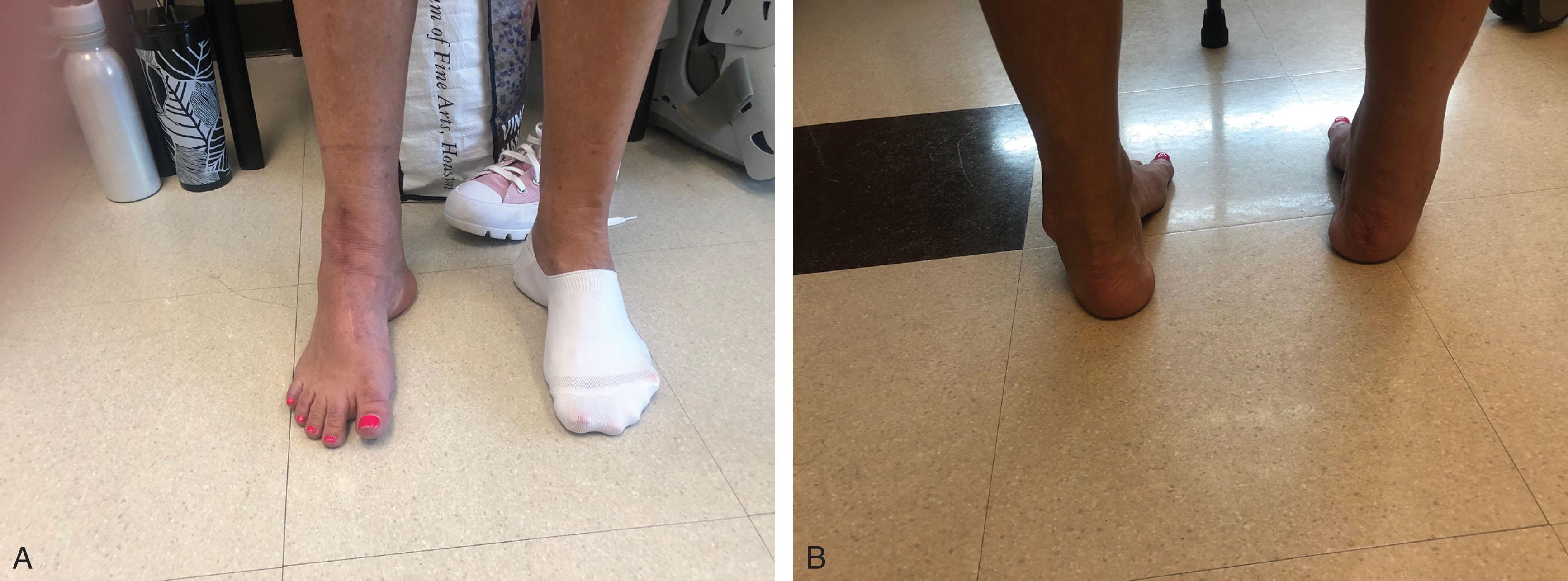 Fig. 37.1, Clinical Photograph of Rigid Cavus Feet. Hindfoot did not correct to neutral with Coleman block testing.