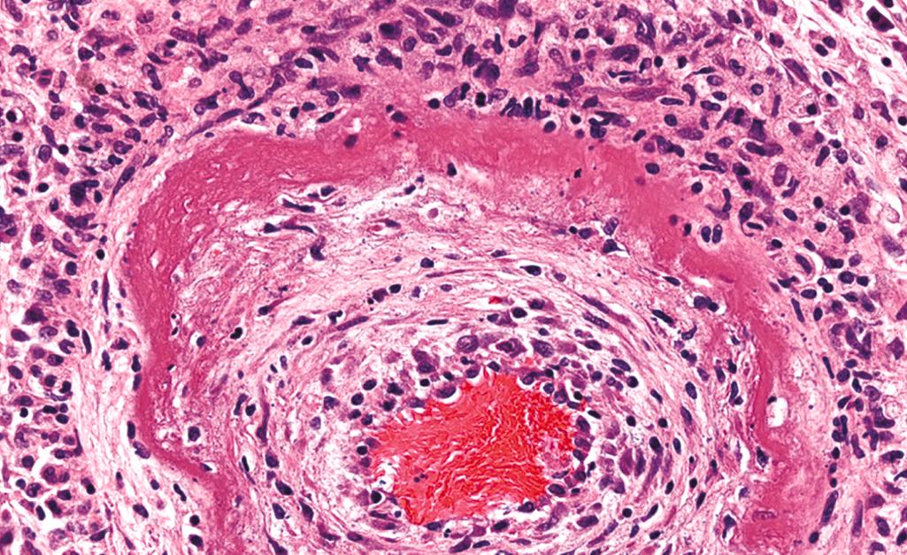 FIG. 1.10, Fibrinoid necrosis in an artery in a patient with polyarteritis nodosa, a form of vasculitis ( Chapter 3 ). The wall of the artery shows a circumferential bright pink area of necrosis with protein deposition and inflammation.