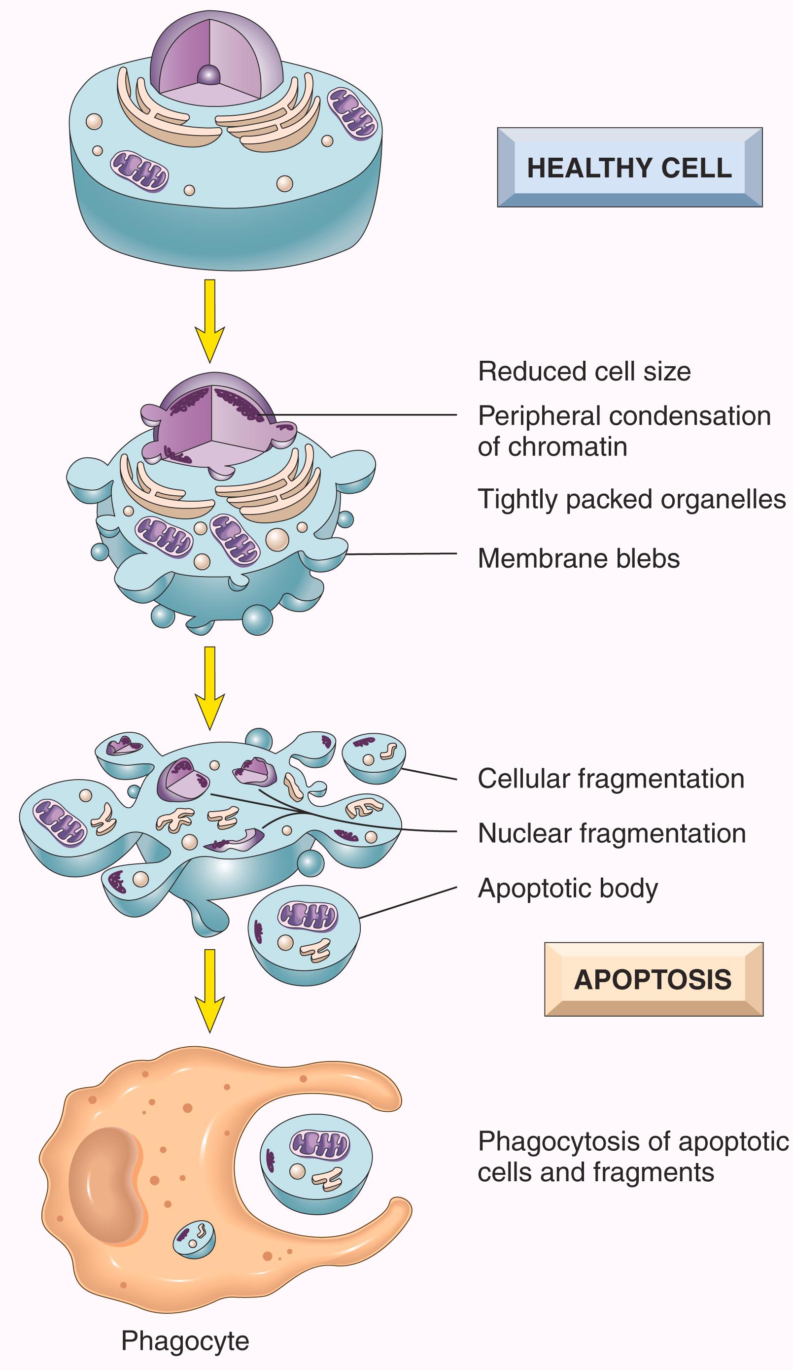 FIG. 1.11, Apoptosis. The cellular alterations in apoptosis are illustrated. Contrast these with the changes that characterize necrotic cell death, shown in Fig. 1.3 .