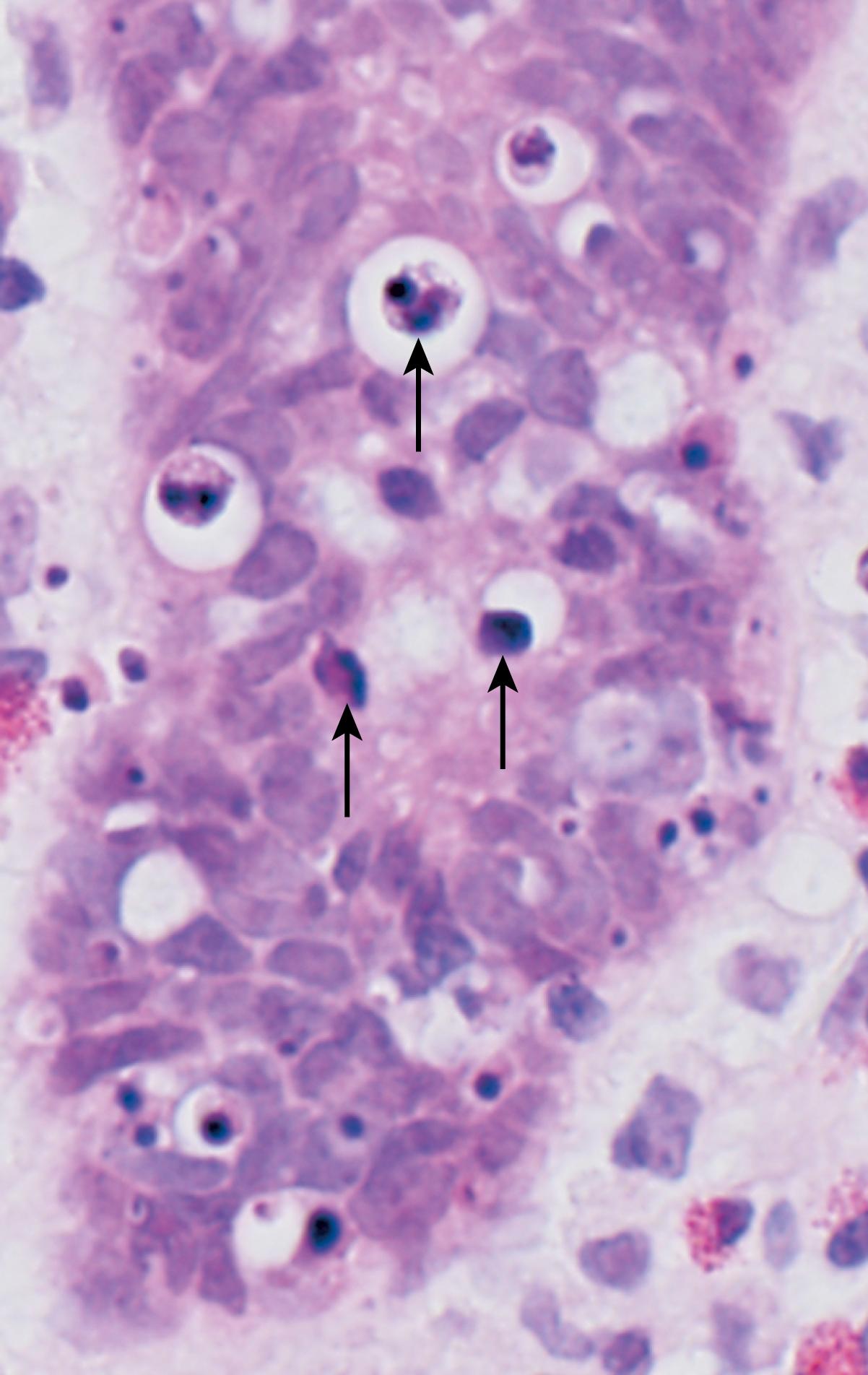 FIG. 1.13, Morphologic appearance of apoptotic cells. Apoptotic cells (some indicated by arrows ) in a normal crypt in the colonic epithelium are shown. (The preparative regimen for colonoscopy frequently induces apoptosis in epithelial cells, which explains the abundance of dead cells in this normal tissue.) Note the fragmented nuclei with condensed chromatin and the shrunken cell bodies, some with pieces falling off.