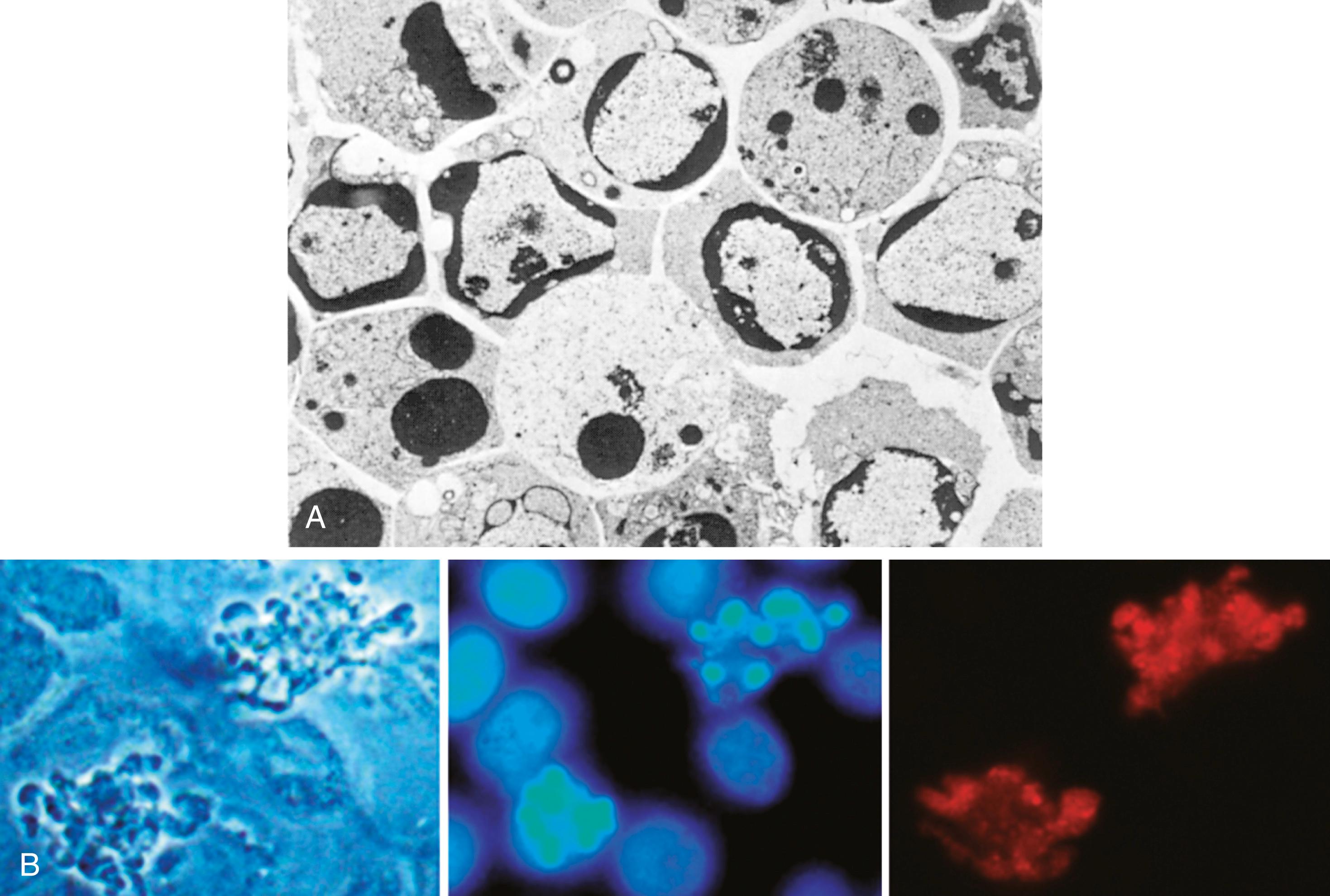 eFIG. 1.2, Morphologic features of apoptosis. (A) This electron micrograph of cultured cells undergoing apoptosis shows some nuclei with peripheral crescents of compacted chromatin, and others that are uniformly dense or fragmented. (B) These images of cultured cells undergoing apoptosis show blebbing and formation of apoptotic bodies ( left panel , phase contrast micrograph), a stain for DNA showing nuclear fragmentation (middle panel) , and activation of caspase-3 ( right panel , immunofluorescence stain with an antibody specific for the active form of caspase-3, revealed as red color).