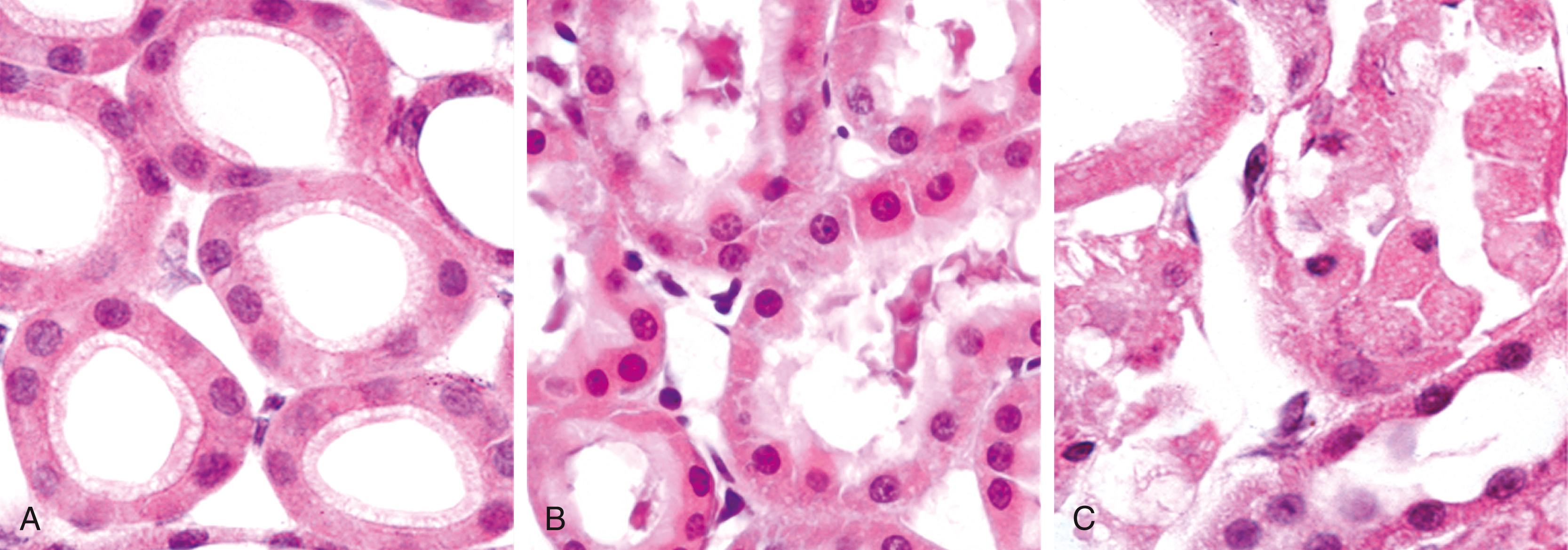 FIG. 1.4, Morphologic changes in reversible cell injury and necrosis. (A) Normal kidney tubules with viable epithelial cells. (B) Early (reversible) ischemic injury showing surface blebs, increased eosinophilia of cytoplasm, and swelling of occasional cells. (C) Necrosis (irreversible injury) of epithelial cells, with loss of nuclei and fragmentation of cells and leakage of contents.